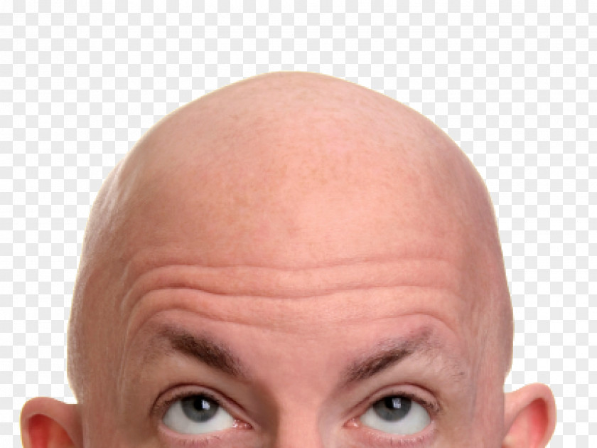 Hair Loss Stem Cell Transplantation Follicle Hairstyle PNG