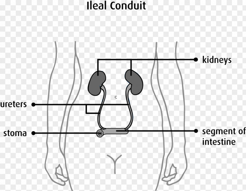 Stoma Urostomy Urinary Diversion Urine Ostomy Pouching System PNG