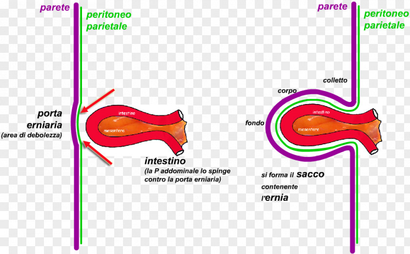 Osso Inguinal Hernia Abdominal Umbilical Schmorl's Nodes PNG