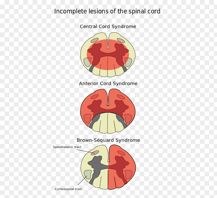 Spinal Cord Injury Anterior Artery Syndrome Central PNG