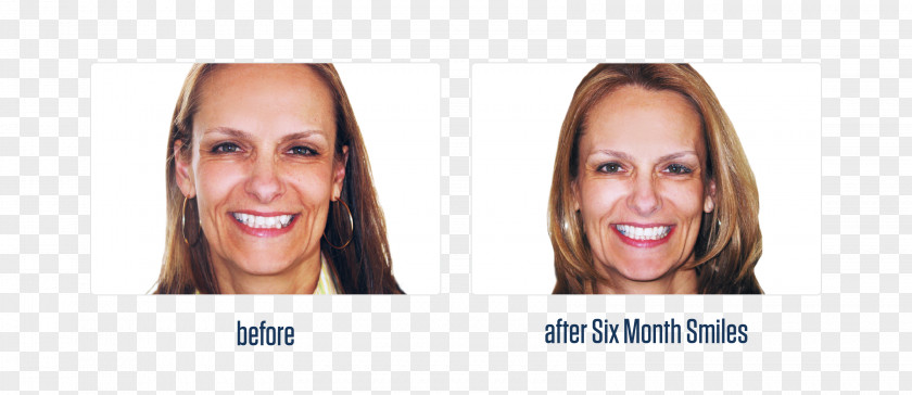 Before And After Cosmetic Dentistry Dental Braces Overbite PNG