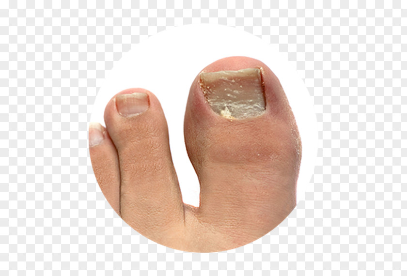 Nail Onychomycosis Athlete's Foot Toe Onychocryptosis PNG
