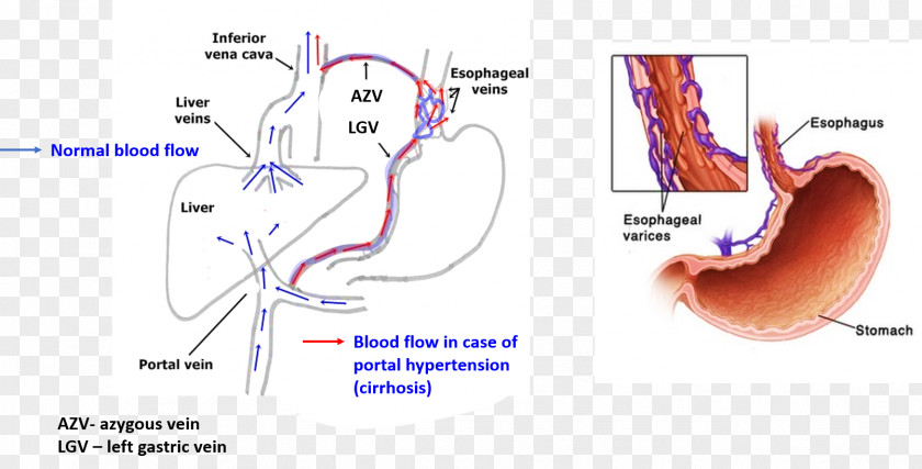 Cranial Nerve Esophageal Varices Esophagus Cirrhosis Portal Hypertension Cancer PNG