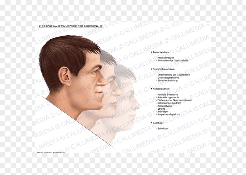 Nose Acromegaly Symptom Pituitary Gland Medical Sign PNG