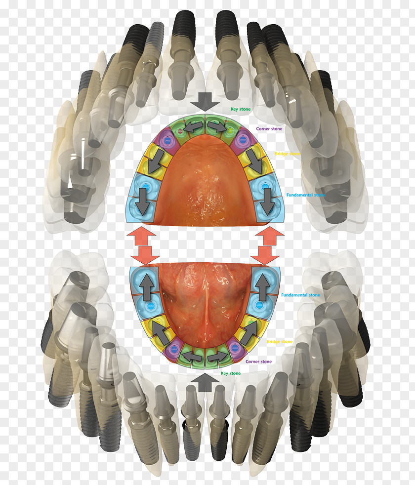 Dental Implant Maxilla Occlusion Tooth PNG