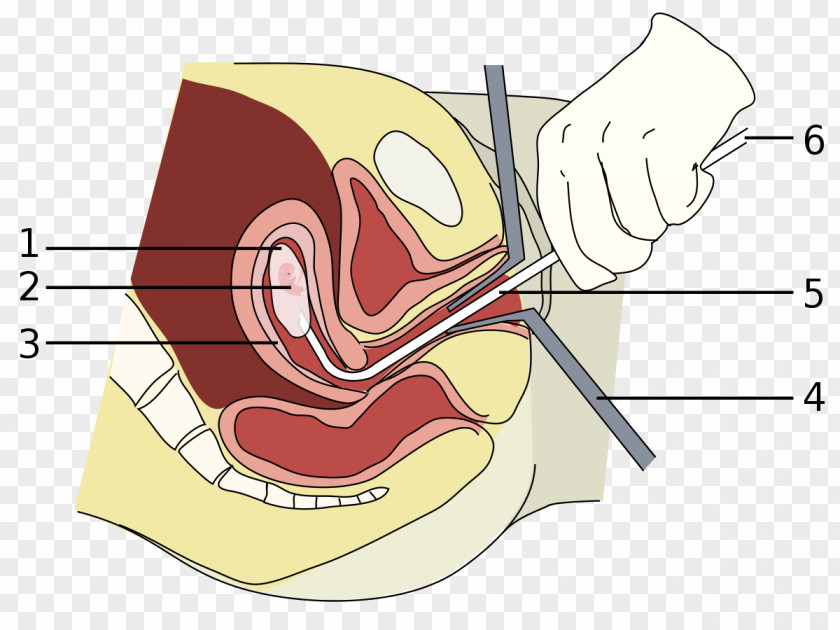 Pregnancy Vacuum Aspiration Miscarriage Abortion Surgery Dilation And Curettage PNG