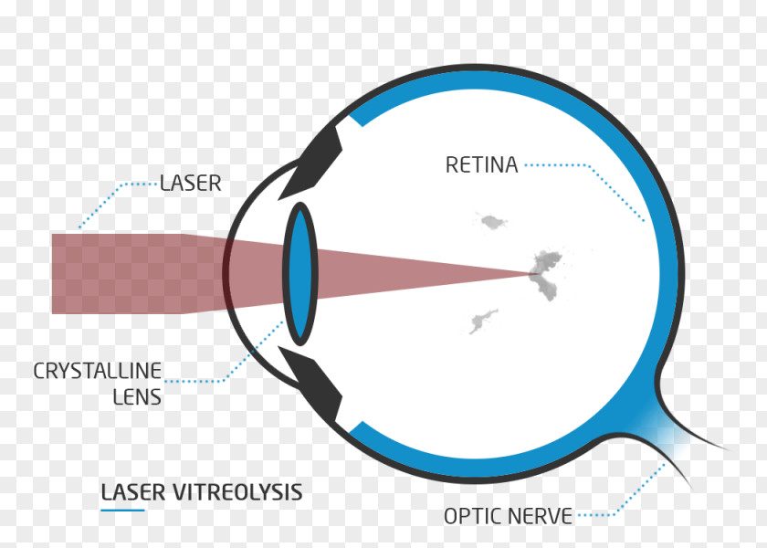 Laser Treatment Presbyopia Far-sightedness Floater Eye Visual Perception PNG