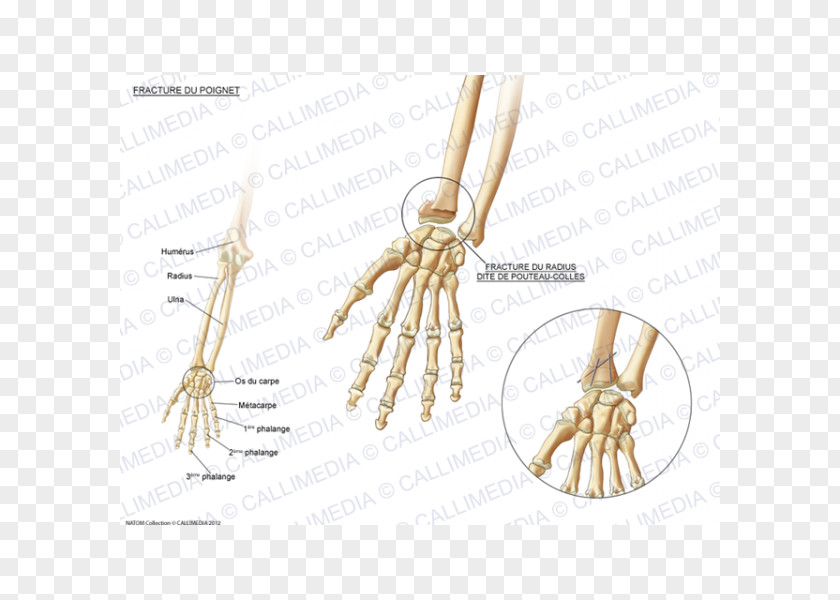 Skeleton Bone Fracture Carpal Bones Wrist Pisiform PNG