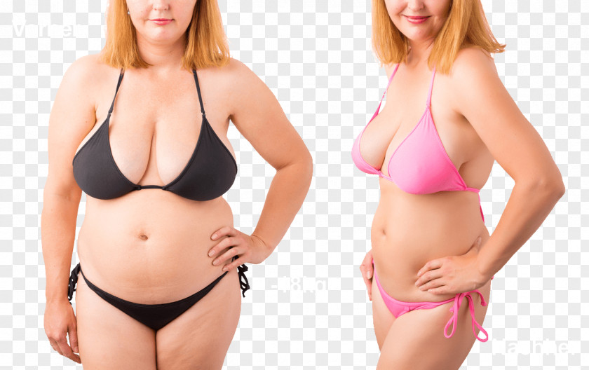 Health Dietary Supplement Adipose Tissue Weight Loss Abdomen Abdominoplasty PNG