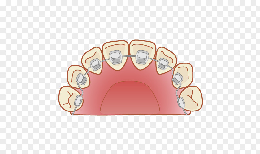 Orthodontics 矯正歯科 Dental Braces Dentist 舌側矯正 PNG