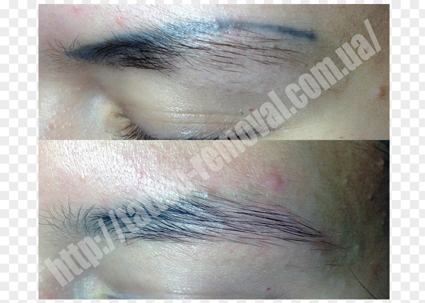 Tattoo Removal Permanent Makeup Scar Laser PNG