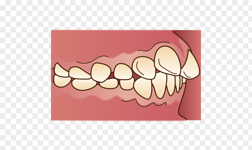 Dental 歯科 Malocclusion Braces Dentition Dentist PNG