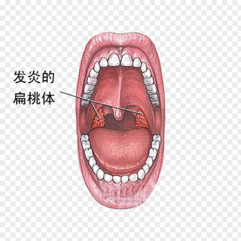 Cancer Lesions Tonsillitis Inflammation Symptom Disease PNG