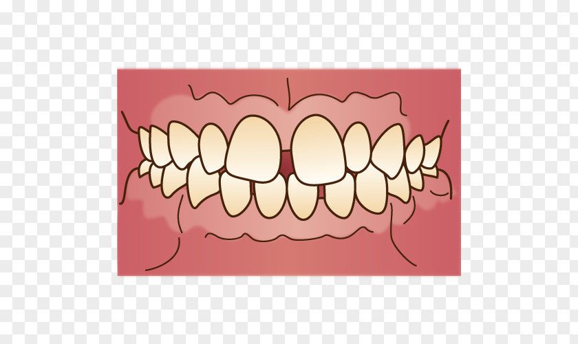 Dental Braces Prognathism Crossbite Malocclusion 歯科 Dentist PNG