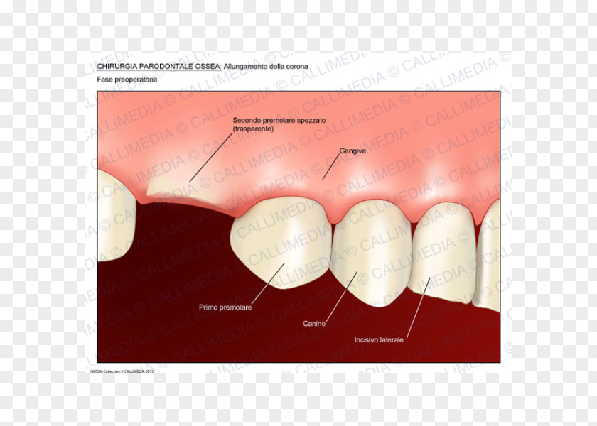 Crown Surgery Lengthening Periodontal Disease Periodontology Medicine PNG