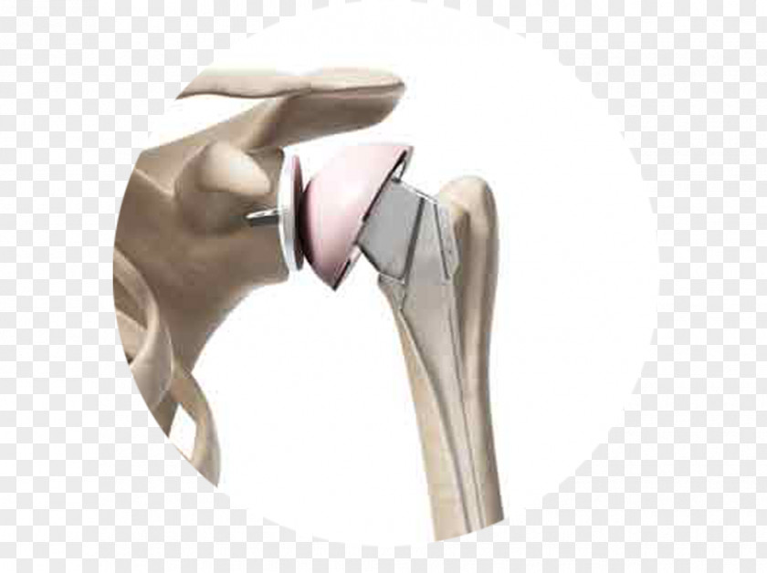 Shoulder Replacement Surgery Joint PNG