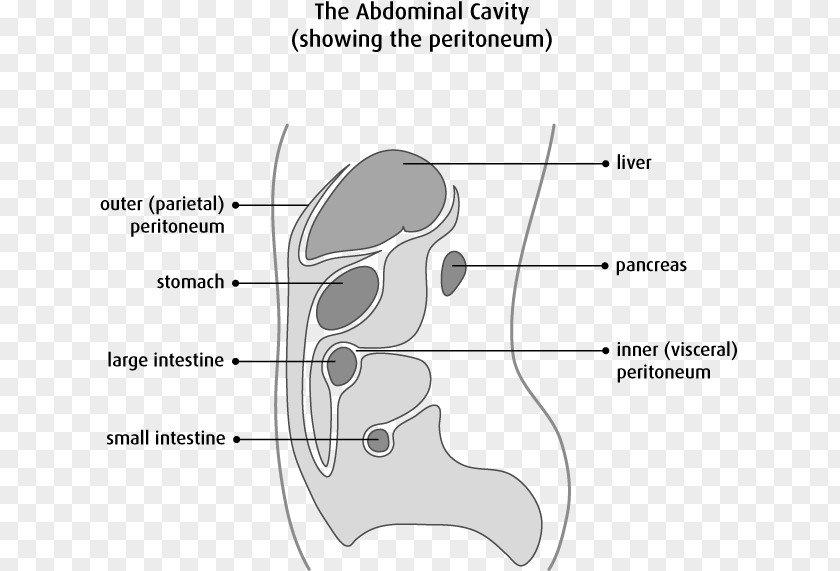 Ascites Peritoneum Mesothelium Peritoneal Mesothelioma Peritonitis Cancer PNG