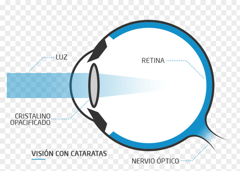 Eye Floater Presbyopia Far-sightedness Near-sightedness PNG