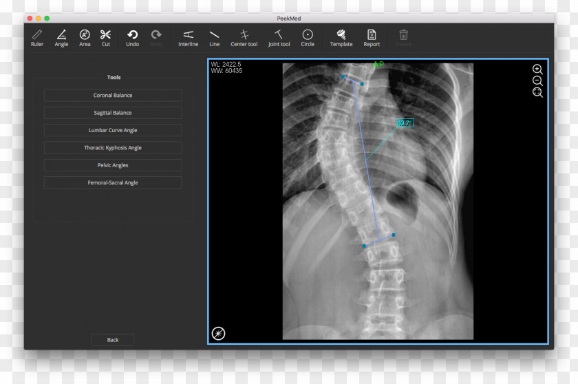Scoliosis X-ray Vertebral Column Radiography Physical Therapy PNG