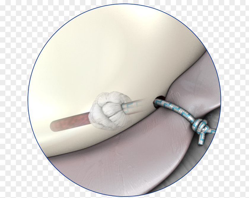 Suture Shoulder Surgery Surgical Medicine Glenoid Labrum PNG