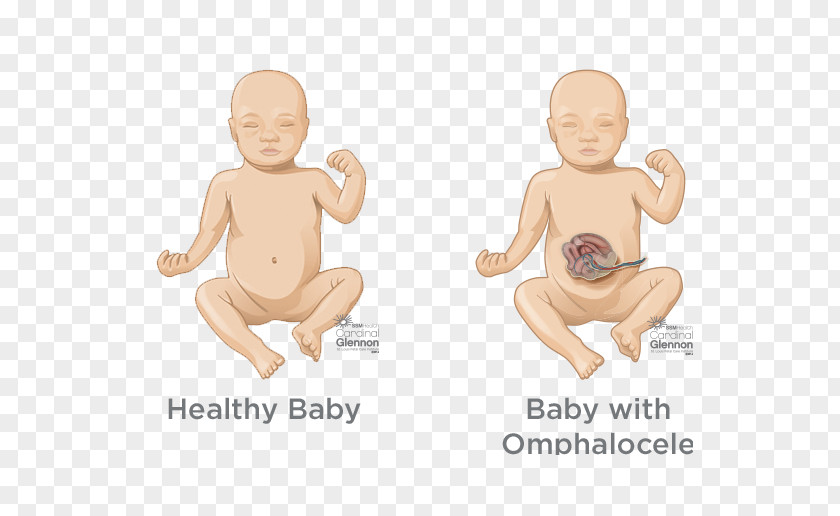 Diagnosis And Treatment Pulmonary Hypoplasia Congenital Airway Malformation Birth Defect Lung Artery PNG