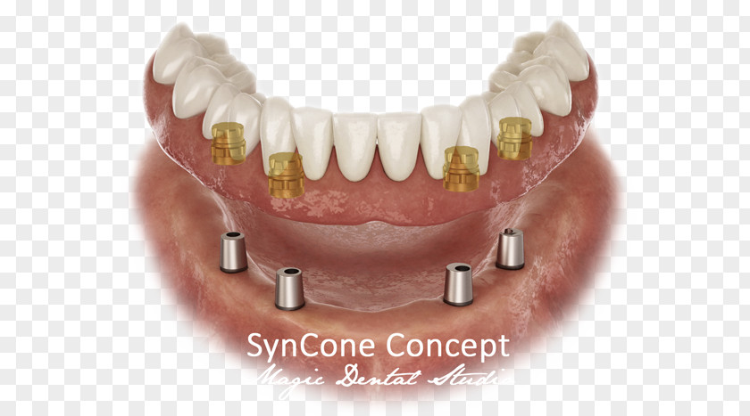 Dental Implant Dentistry Dentures Prosthesis PNG