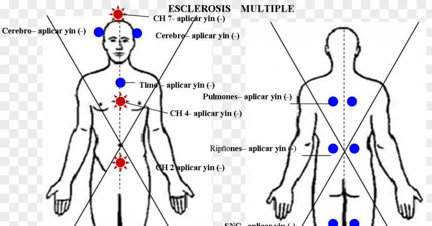 Multiple Sclerosis Human Body Anatomy Free Diagram Muscular System PNG