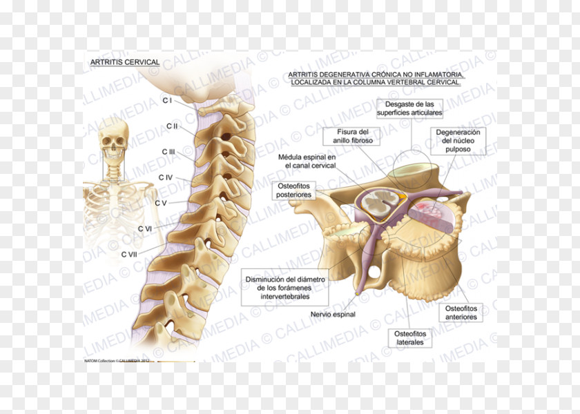Ráº¯n 3d Cervical Osteoarthritis Vertebrae Vertebral Column PNG
