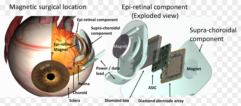 Eye Visual Prosthesis Retinal Implant PNG