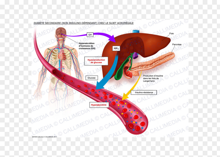 Acromegalia Insulinodependencia Diabetes Mellitus Type 1 2 PNG