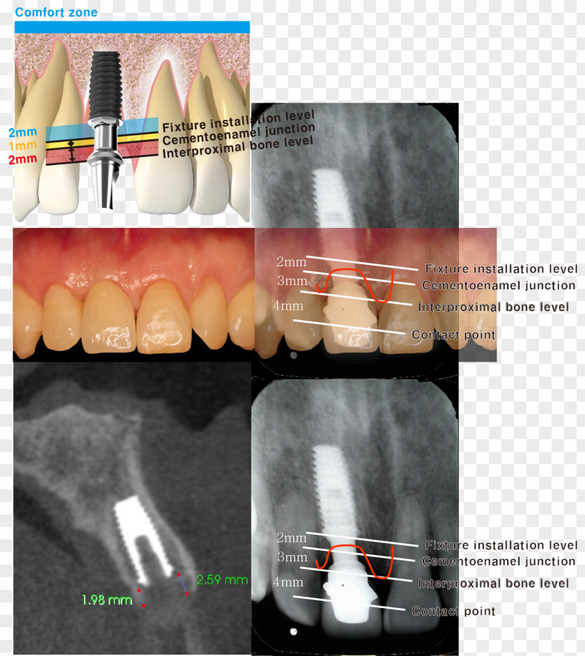 Location Board Dental Implant Cementoenamel Junction Tooth Dentistry Maxillary Sinus PNG