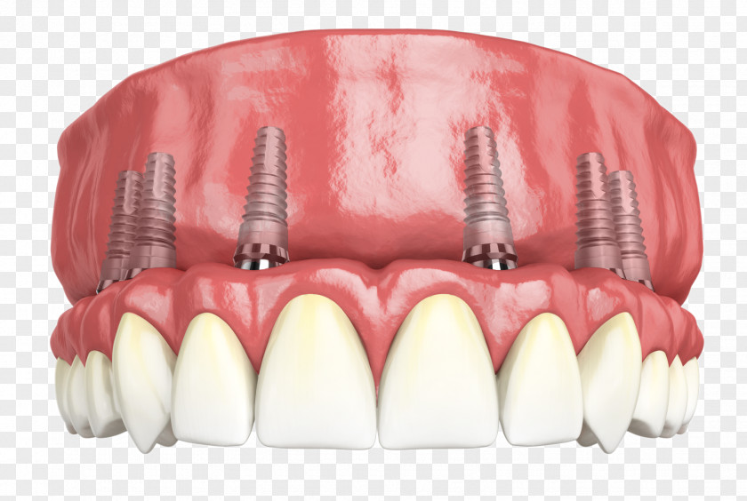 Dental Restoration Hybridge Implants Giesy Family And Implant Dentistry PNG