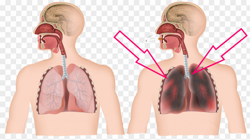 Lunges Chronic Obstructive Pulmonary Disease Tobacco Smoking Pulmonology Dyspnea PNG