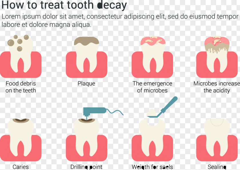 How To Treat Dental Caries Infographic Vector Material Tooth Decay Dentistry Euclidean PNG