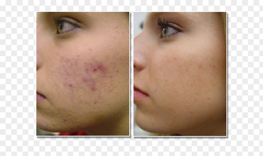 Skin Clinic Scar Acne Chemical Peel LA SkinAesthetics Exfoliation PNG
