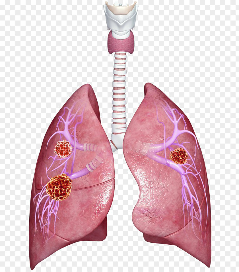 Metastasis Lung Cancer Organ PNG cancer Organ, organ clipart PNG