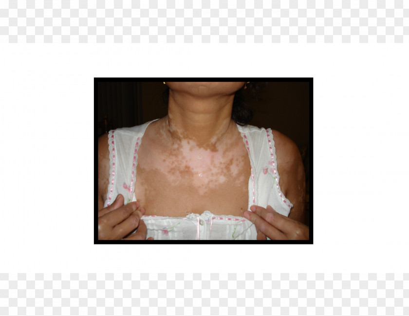 Health Vitiligo Disease Skin Therapy PNG