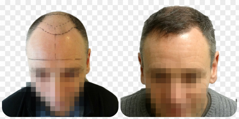 Mupai Hair Transplantation Follicular Unit Extraction Forehead Eyebrow PNG