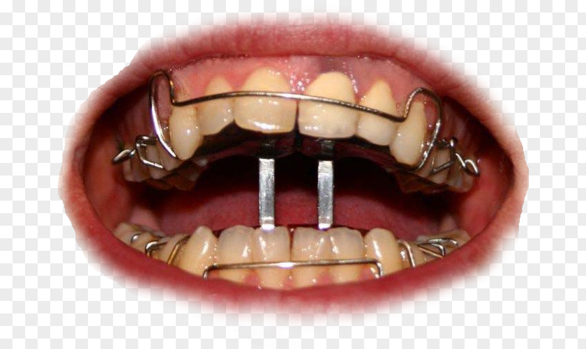 Lose Dental Braces Orthodontics Dentistry Tooth Clear Aligners PNG