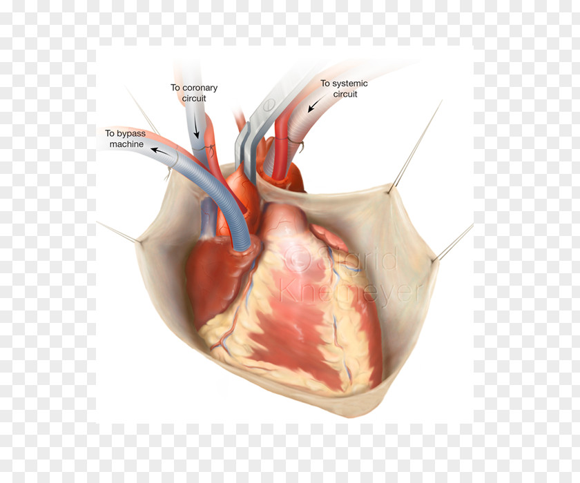 Heart Coronary Artery Bypass Surgery Vascular Off-pump Disease PNG