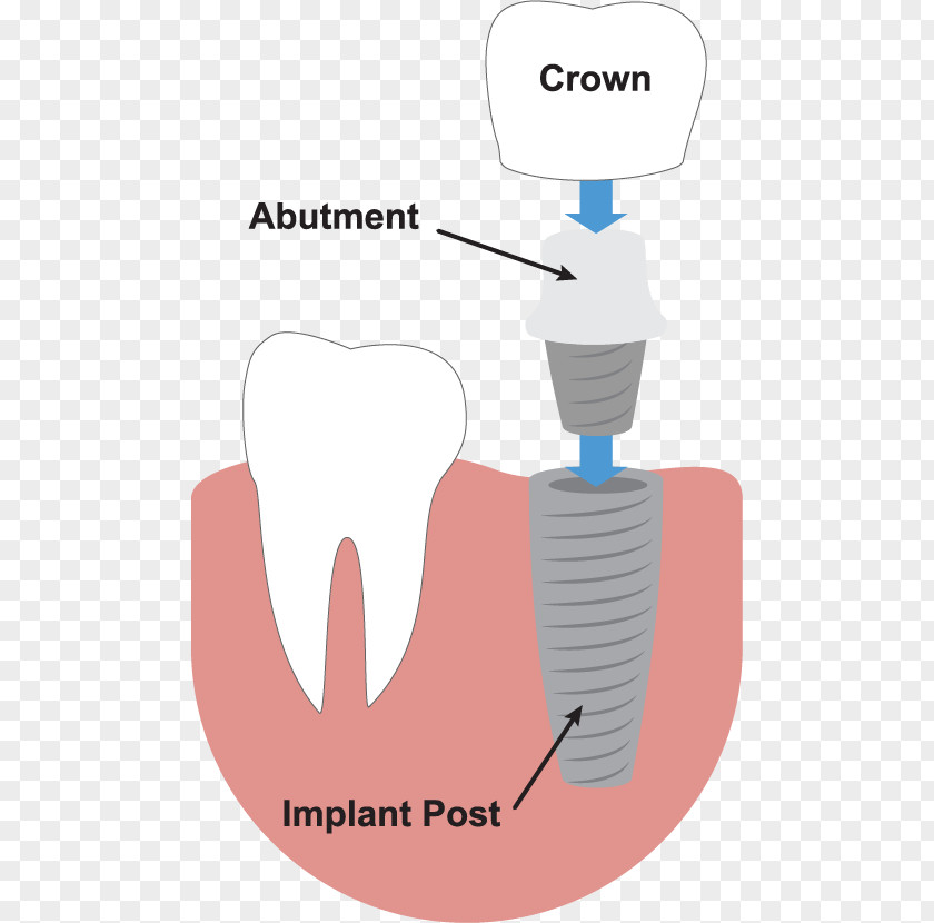 Dental Implants Tooth Implant Dentistry Dentures PNG