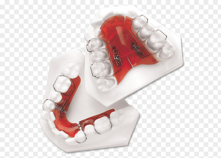 Palatal Expansion Sagittal Plane Coronal Finger Distal Occlusion PNG