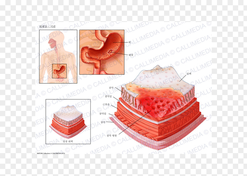 Ulcer Peptic Disease Skin Erosion Mucous Membrane Mouth PNG