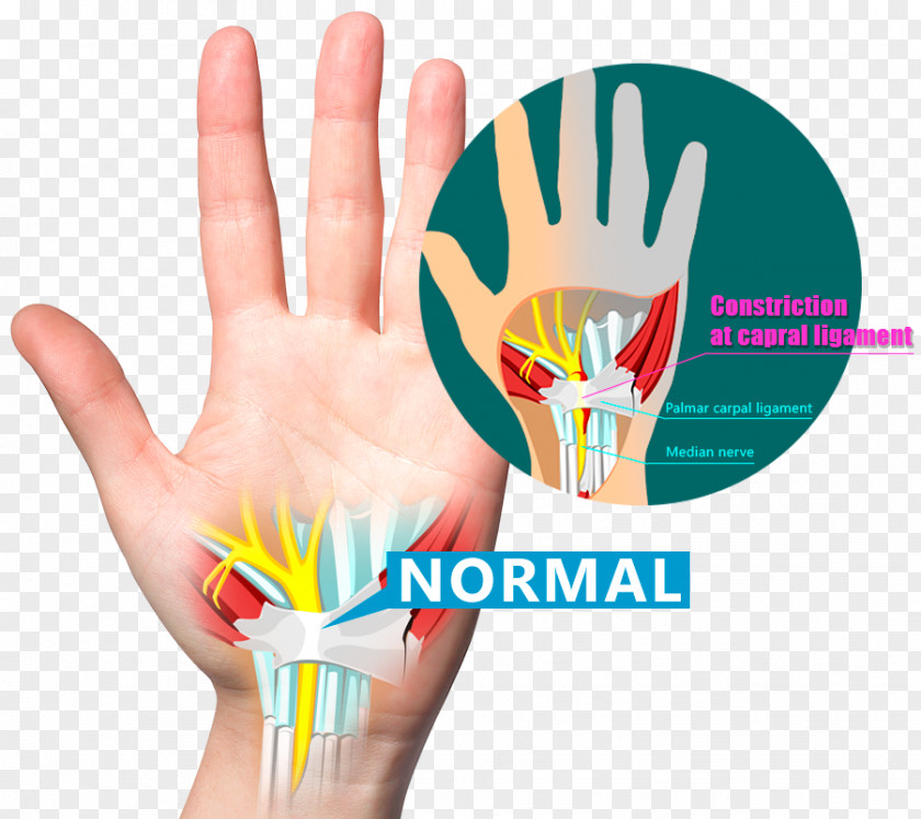 Hand Wrist Pain Carpal Bones Tunnel Syndrome Ligament PNG