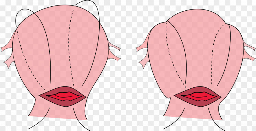 Stitch B-Lynch Suture Surgical Postpartum Hemorrhage Uterine Atony Uterus PNG