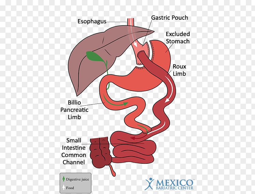 Small Intestine Gastric Bypass Surgery Bariatric Sleeve Gastrectomy Balloon PNG