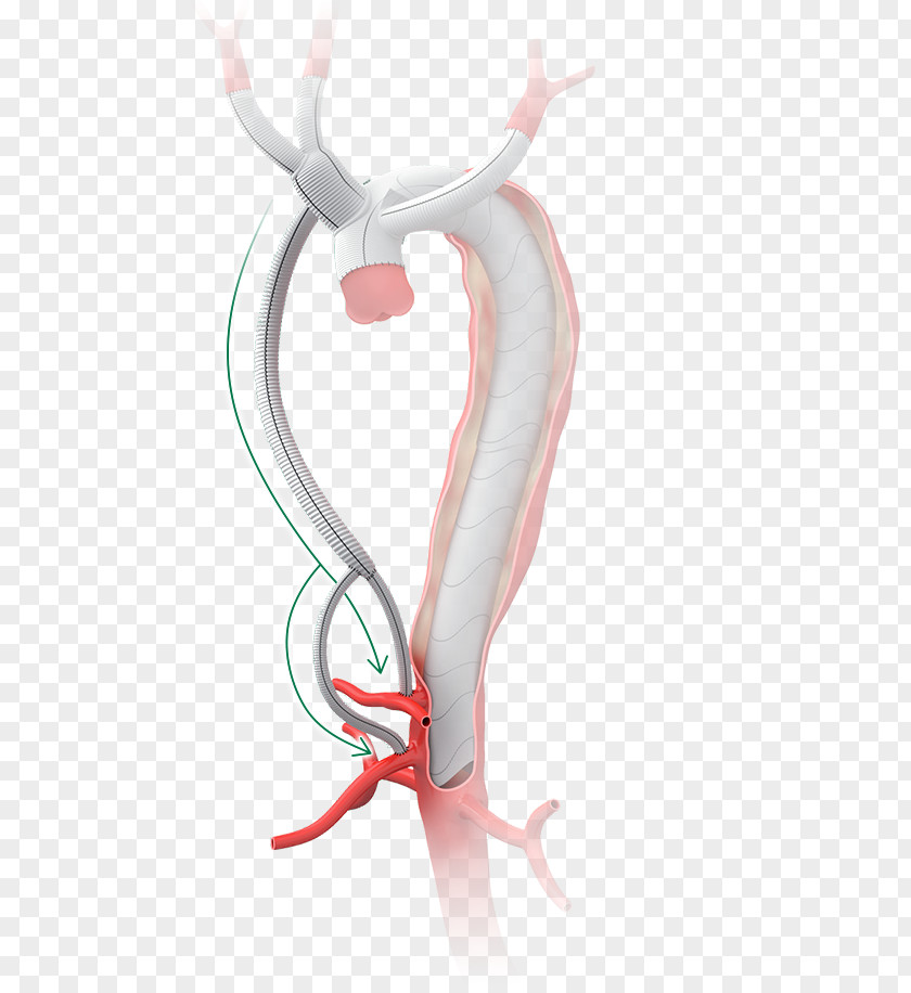 Surgery Graft Aorta Aortic Dissection Anastomosis PNG