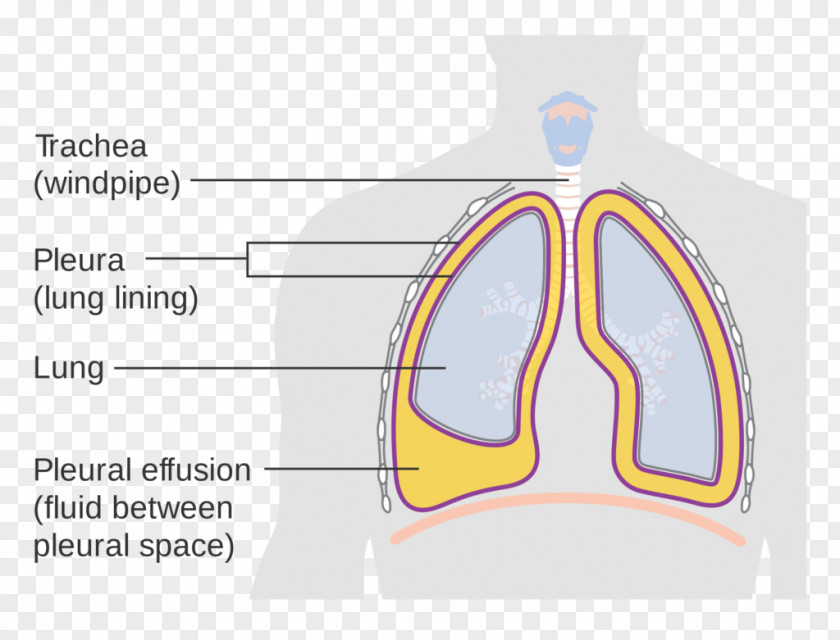 ICD-10 Pleural Effusion Cavity Lung PNG