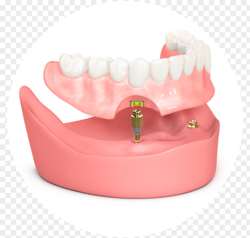 Tooth Dental Implant Dentistry Dentures Prosthesis PNG