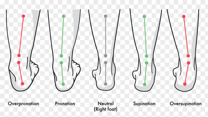 Pronation Of The Foot Supination Gait Achilles Tendinitis PNG